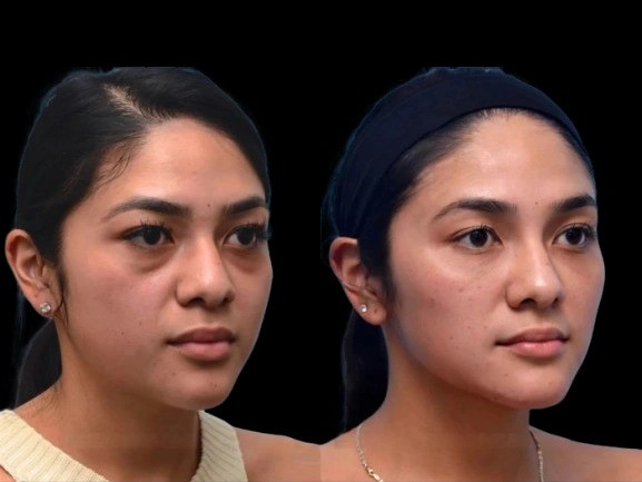 Top 5 Treatments for Dark Circles at the Best Aesthetic Clinic in Dubai