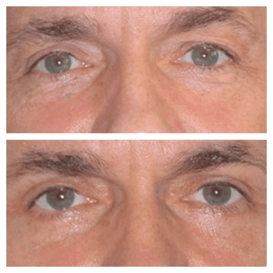 Eye Bag Removal in Dubai: Understanding Tear Trough Fillers
