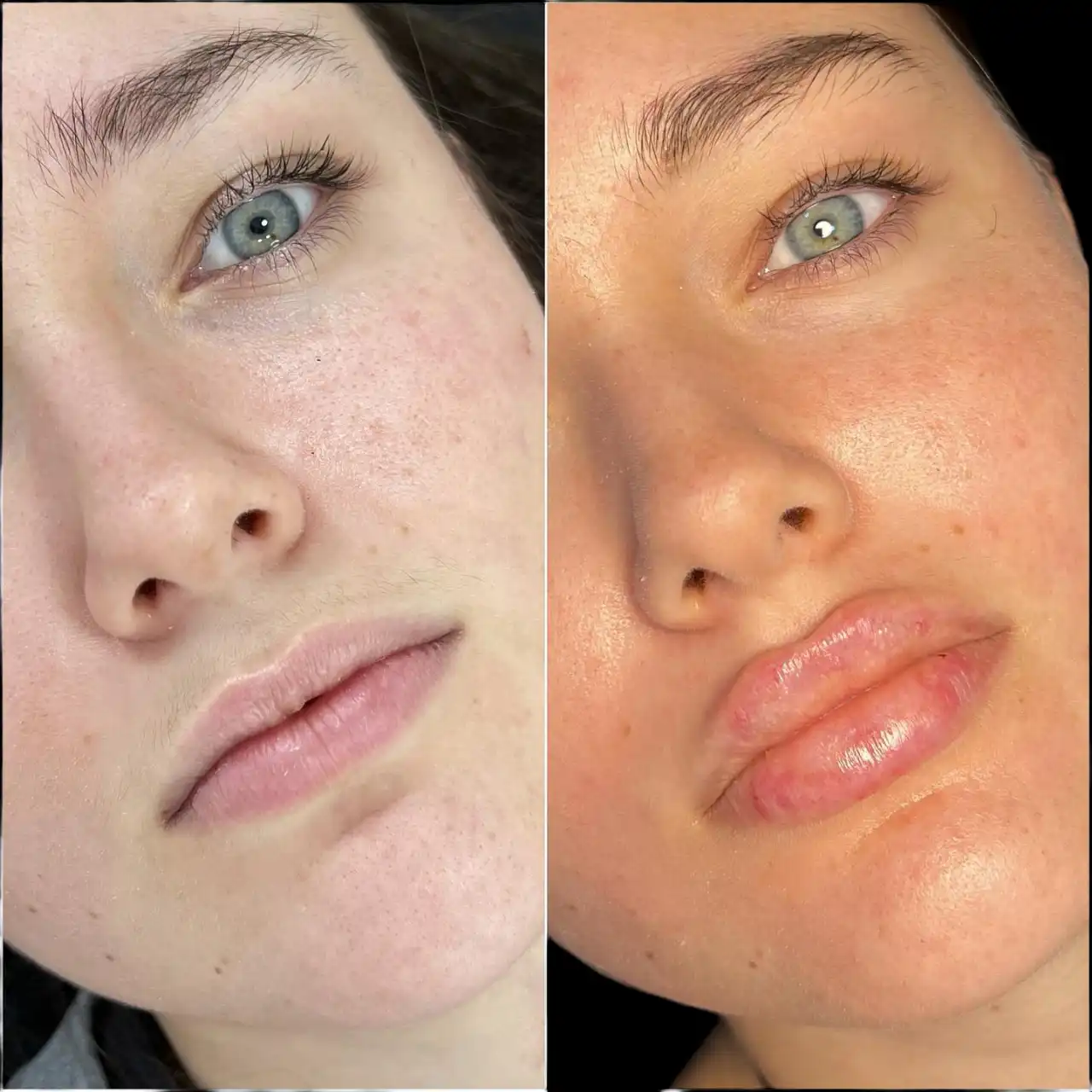 Best Doctors in dubai for Fillers for Modern Beauty Solutions