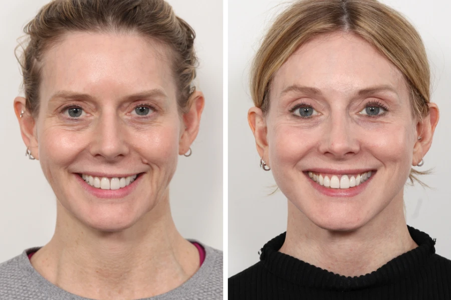 Best Doctors in Dubai for Thread Lift Facial Youth Enhancement