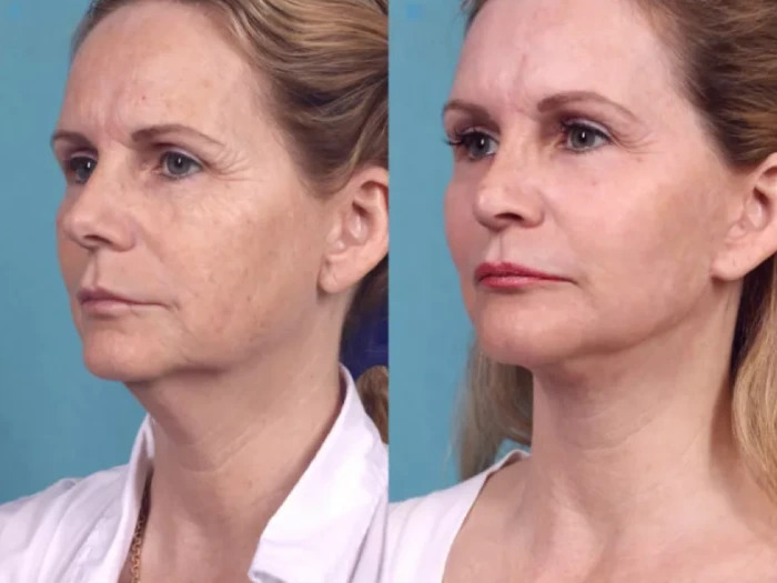 Best Doctors in dubai for Chemical Peels and Complete Skin Transformation