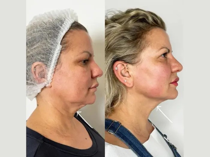 Cheek and Midface Lift with Endolift Performed by Best Doctors in Dubai