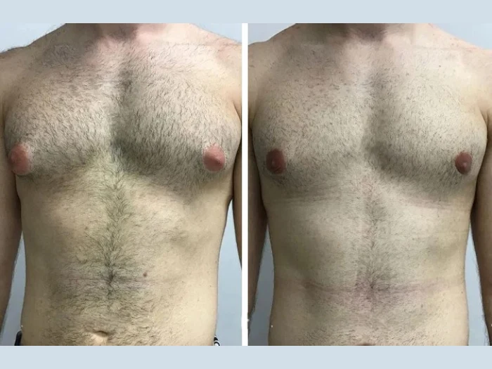 Gynecomastia in Dubai: Medical Safety Standards You Should Know