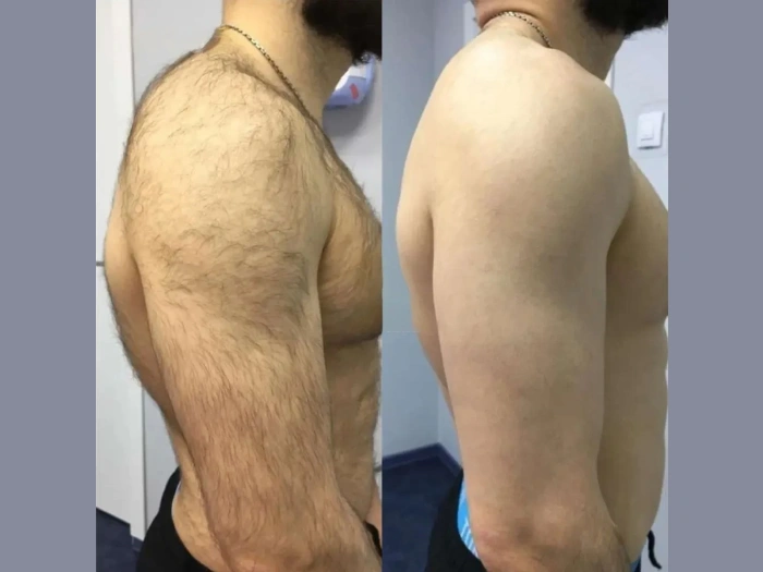 Best Doctors in dubai Discuss Why Teens Are Choosing Laser Hair Removal More Than Ever