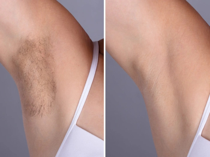 Best Doctors in dubai for Beginners in Electrolysis Laser hair removal