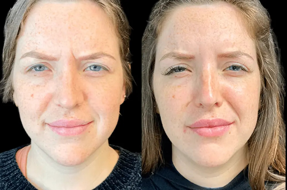 Best Doctors in Dubai for Botox: Achieving Youthful and Refreshed Skin