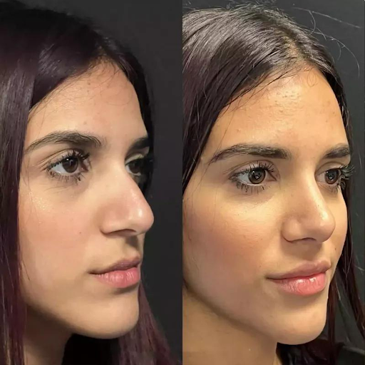 Affordable Excellence in Dubai: Choosing the Best Rhinoplasty Surgeon