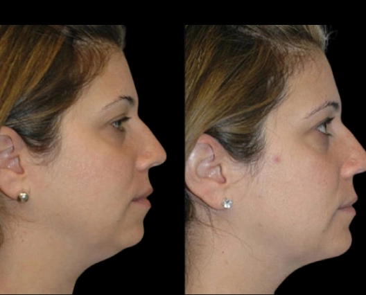 Double chin removal in Dubai for women: Popular procedures