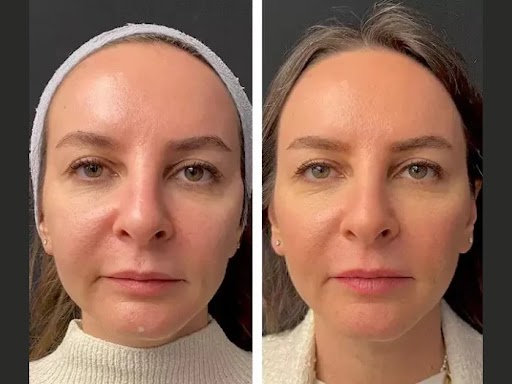 Best Aesthetic Clinic in Dubai for Mesotherapy Treatment – Top Clinics You Can Trust