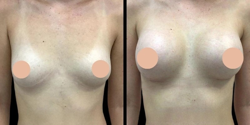 Who Is an Ideal Candidate According to the Best breast augmentation Surgeon in Dubai