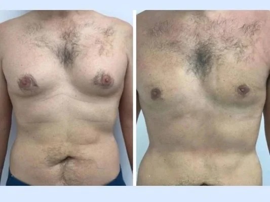 Best Gynecomastia Surgeon in dubai: Long-Term Results and Expectations